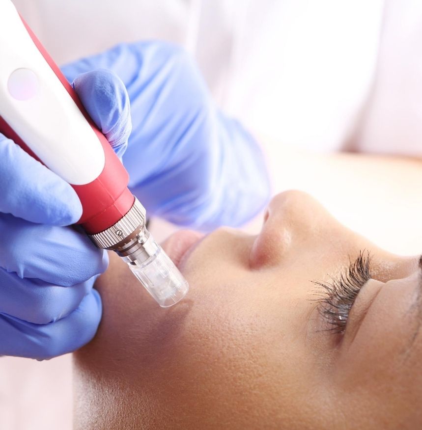 zabieg mezoterapii mikroigłowej w salonie kosmetycznym
