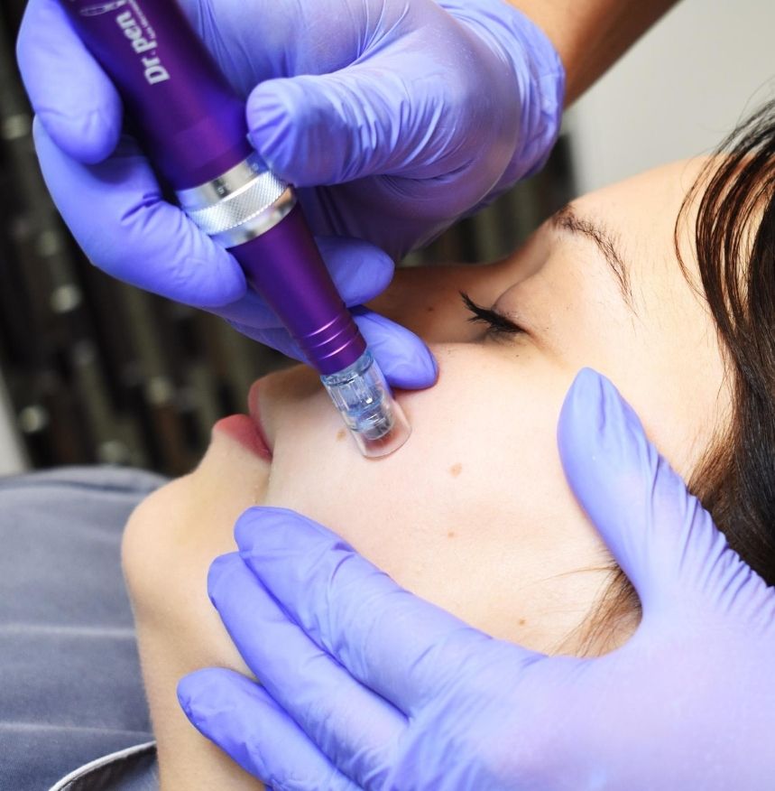 dermapen zabieg na twarz, salon kosmetyczny Kłodzko